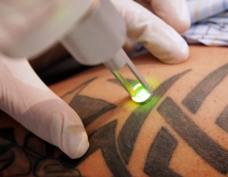 Лазерное удаление тату и татуажа